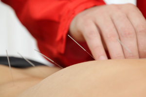 Akupunktura - bolesti v zádech